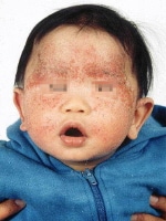 Contact Dermatitis Causes