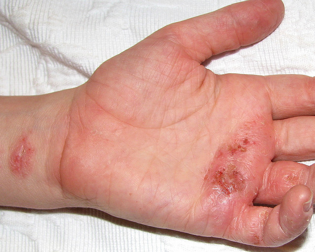 Contact Dermatitis Causes