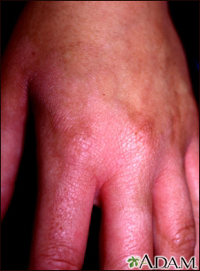 Contact Dermatitis Causes