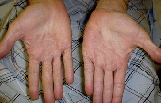 Contact Dermatitis Fingers
