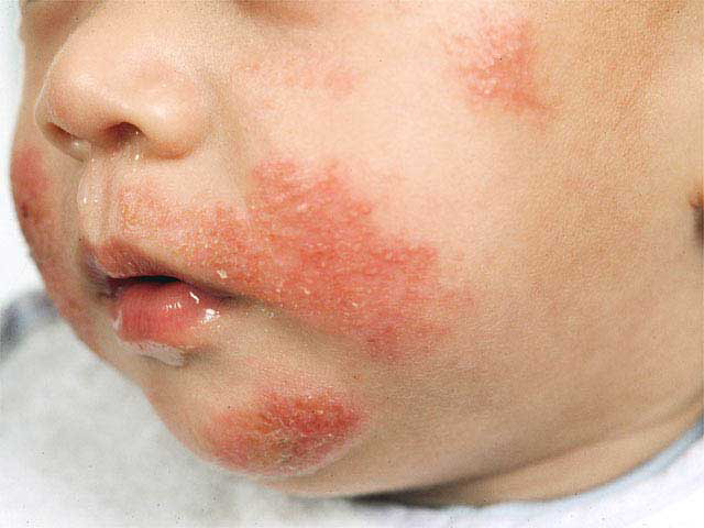 Contact Dermatitis In Babies