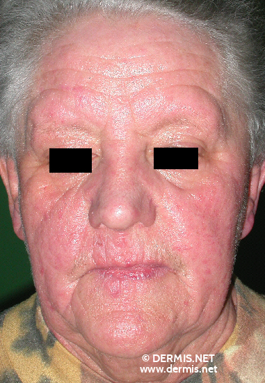 Contact Dermatitis On Face