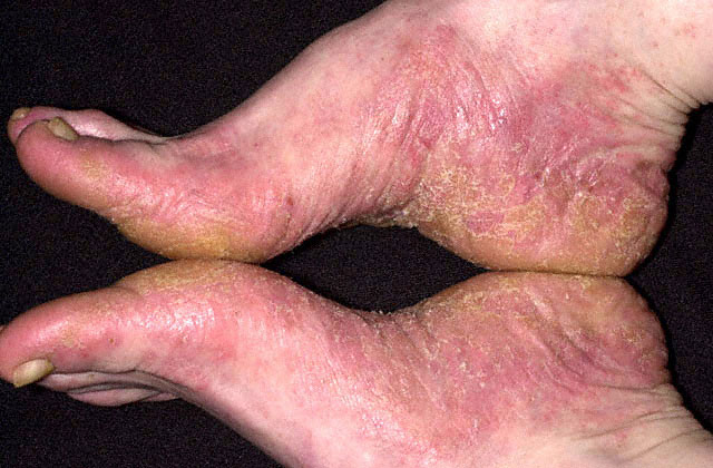 Contact Dermatitis Pics