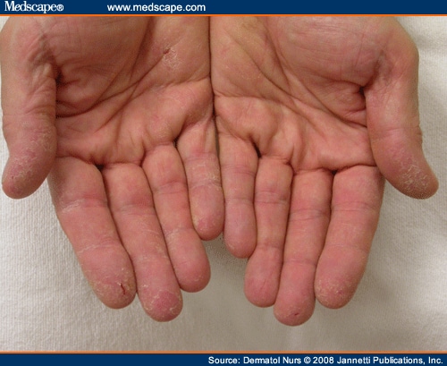 Contact Dermatitis Pics