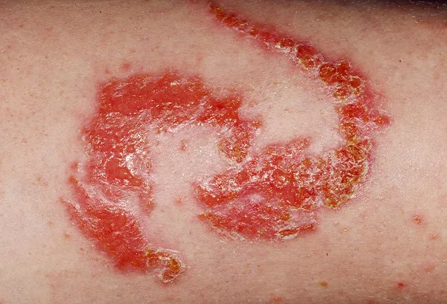 Contact Dermatitis Pictures