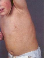 Contact Dermatitis Pictures Children