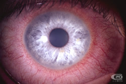 Contact Lens Red Eye