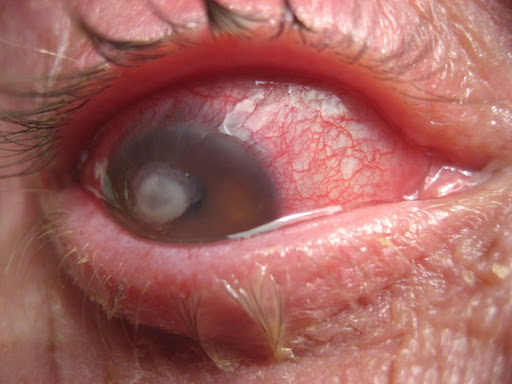 Contact Lens Red Eye Problem