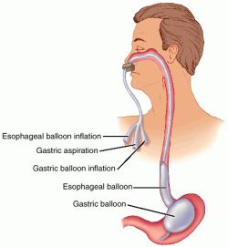 Enteral Feeding Tubes