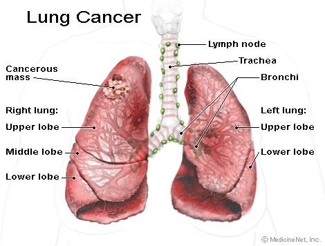 Lung Cancer Cells Images