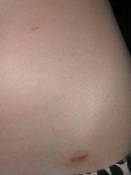 Marilyn Monroe Appendix Scar