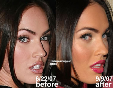 Megan Fox Before And After Surgery Pics