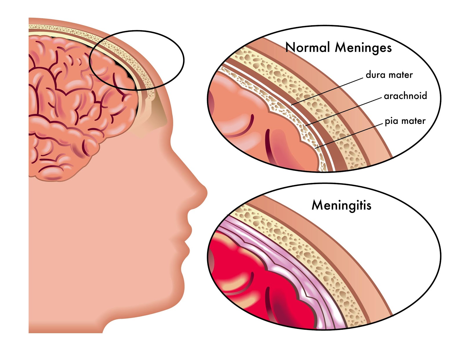 Meningitis In Children