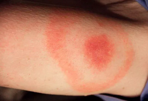 Meningitis Rash Pictures