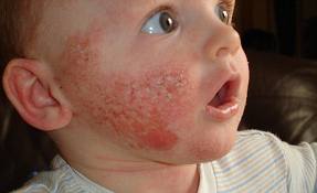 Meningitis Rash Pictures In Babies