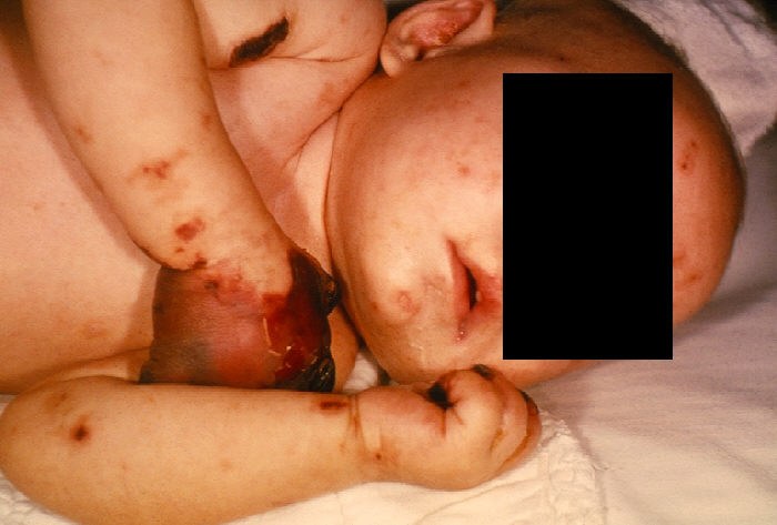 Meningitis Symptoms In Babies
