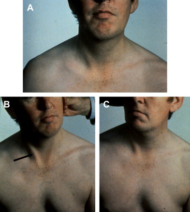 Spinal Accessory Nerve Injury Symptoms