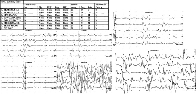 Spinal Accessory Nerve Palsy Symptoms