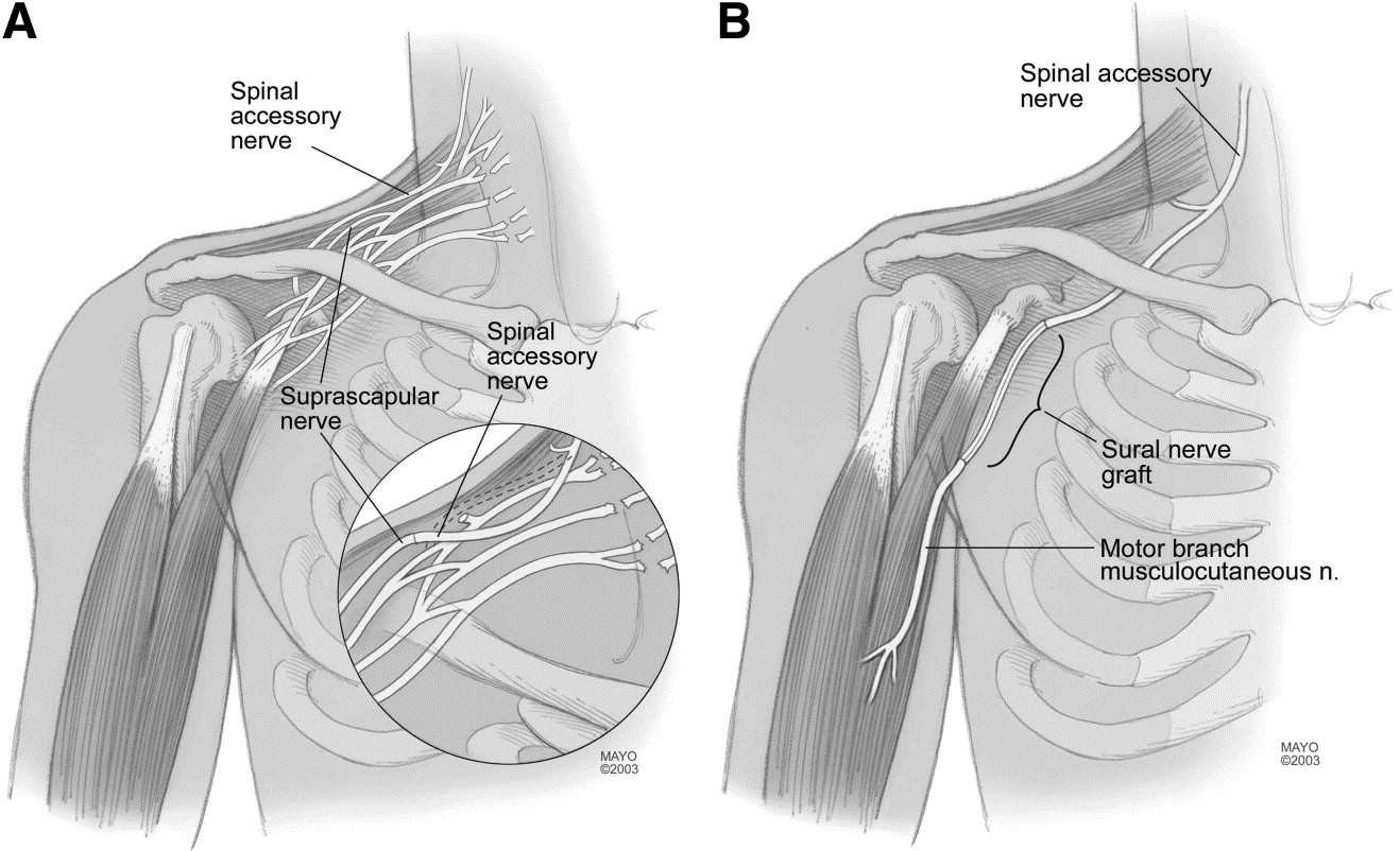 Spinal Accessory Nerve Palsy Treatment