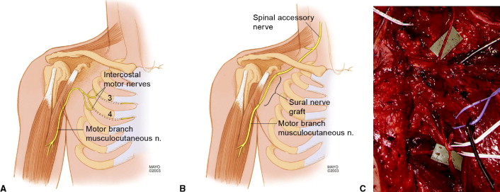Spinal Accessory Nerve Palsy Treatment