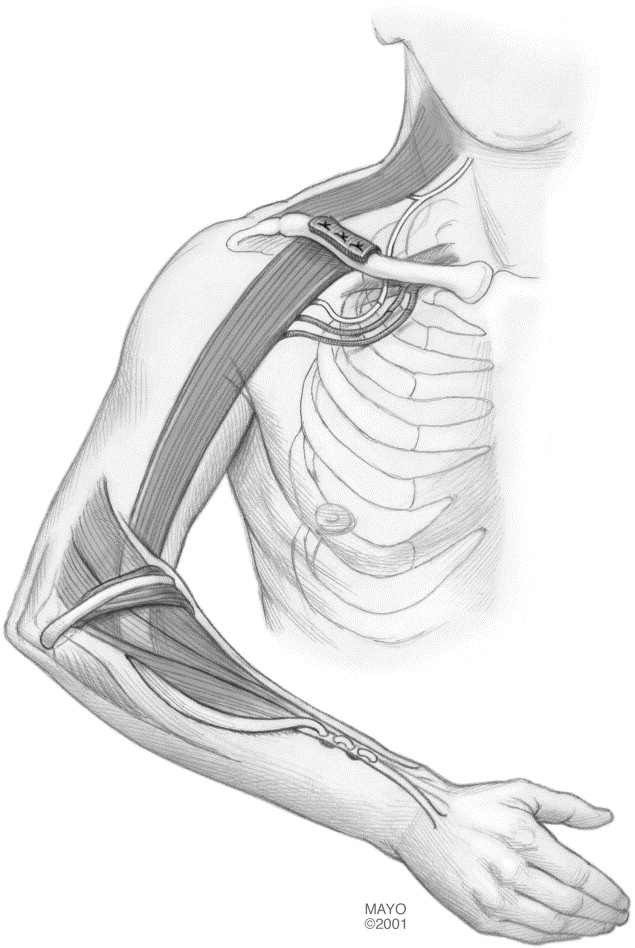 Spinal Accessory Nerve Palsy Treatment