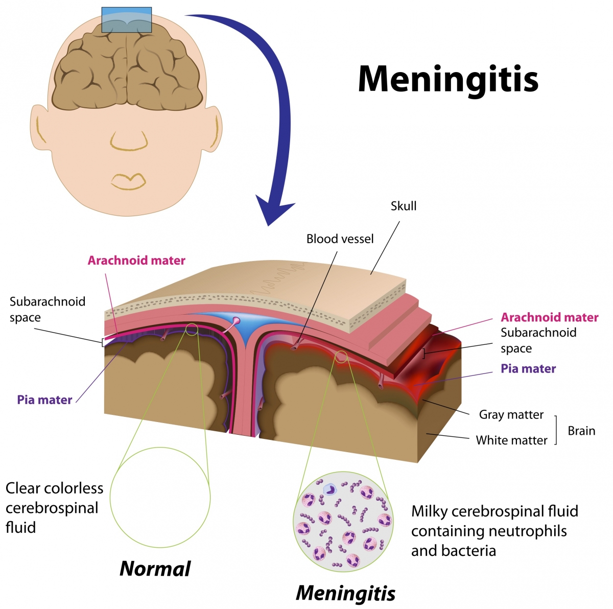 Spinal Meningitis Symptoms In Infants