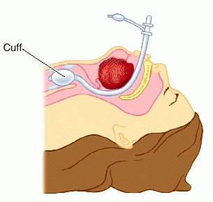 Types Of Feeding Tubes For Dogs