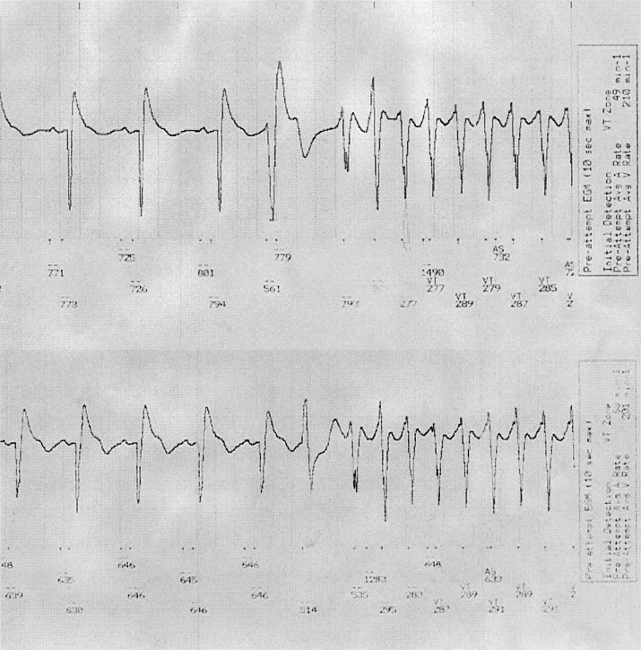 Ventricular Ectopy Icd 9