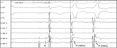 Ventricular Ectopy Icd 9