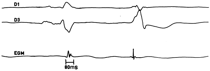 Ventricular Ectopy Icd 9