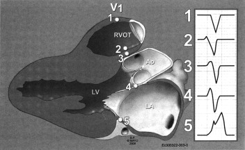 Ventricular Ectopy Icd 9