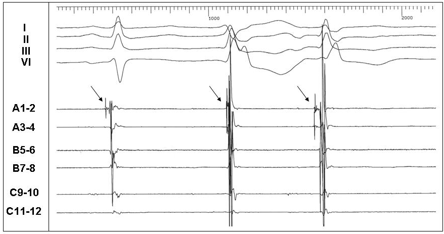 Ventricular Ectopy Treatment