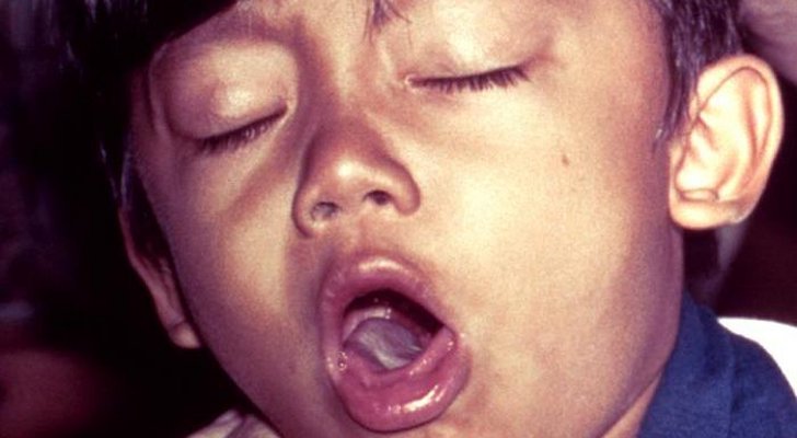 Whooping Cough Vaccine Side Effects